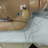 ecmo