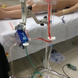ecmo