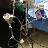 ecmo
