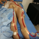 ecmo