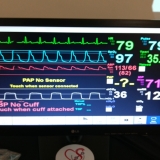 ecmo